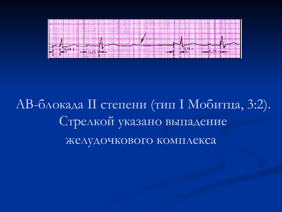 Ав блокада 2 степени. АВ блокада 2 степени Мобитц 3. Av блокада 2 степени Тип Мобитца. АВ-блокады II степени, II типа Мобитца:. АВ блокада 2 степени 2 типа.