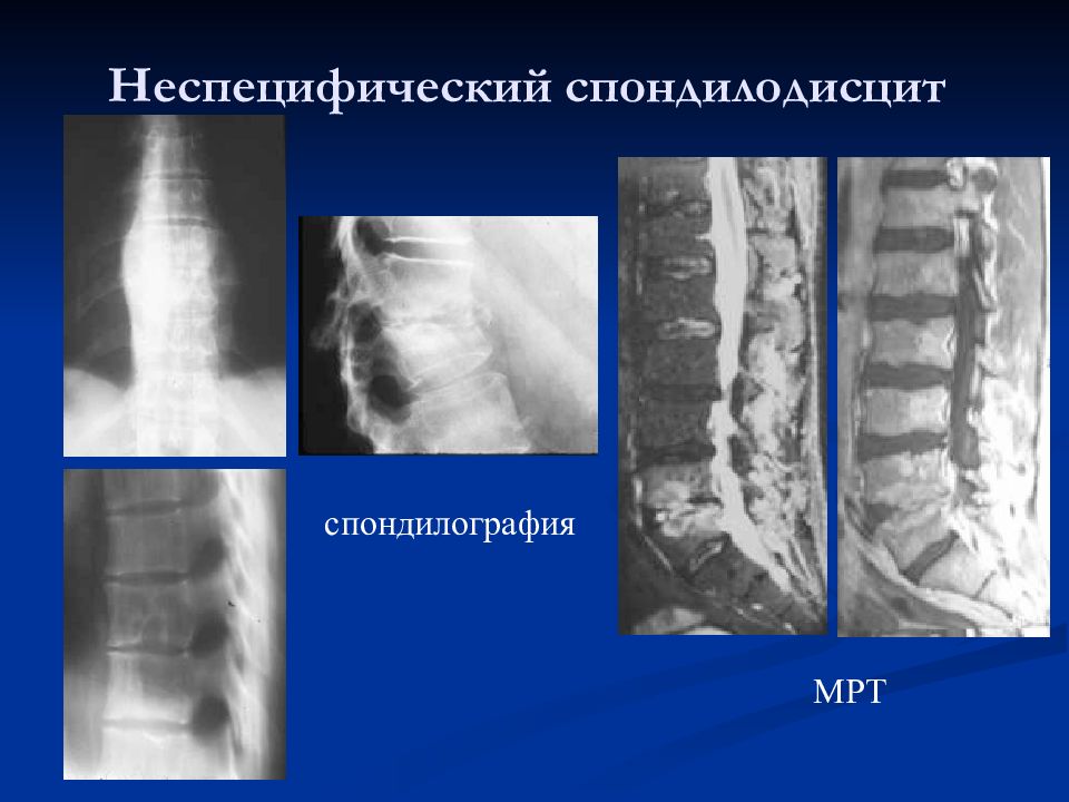 Спондилодисцит мрт картина