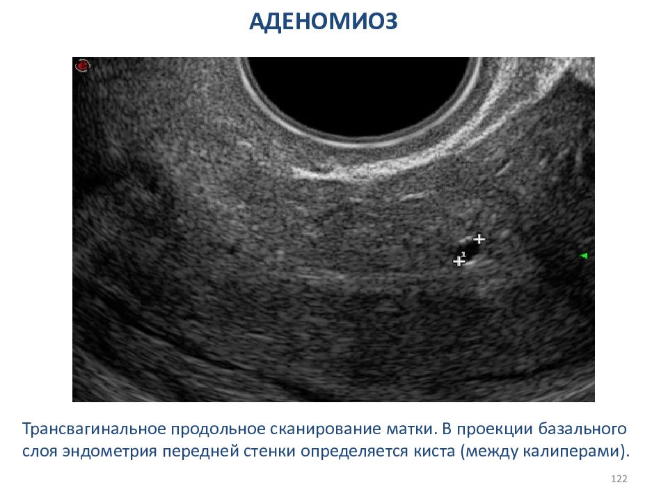 Эндометрия стенок матки. Гиперэхогенный полип эндометрия. Аденомиоз по УЗИ признаки. Гиперэхогенные образование эндометрия УЗИ.