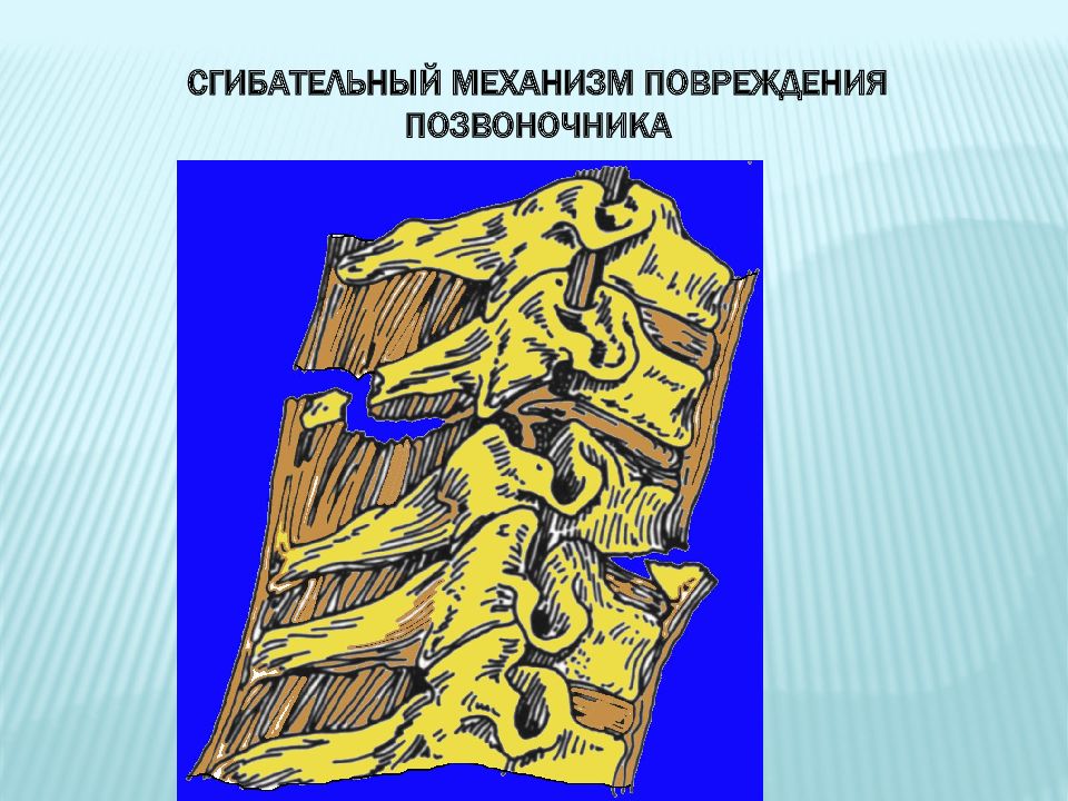 Повреждение позвоночника. Сгибательный механизм повреждения позвоночника. Травмы позвоночника презентация. Серьезную травму позвоночника. Классификация повреждение позвоночника и таза.