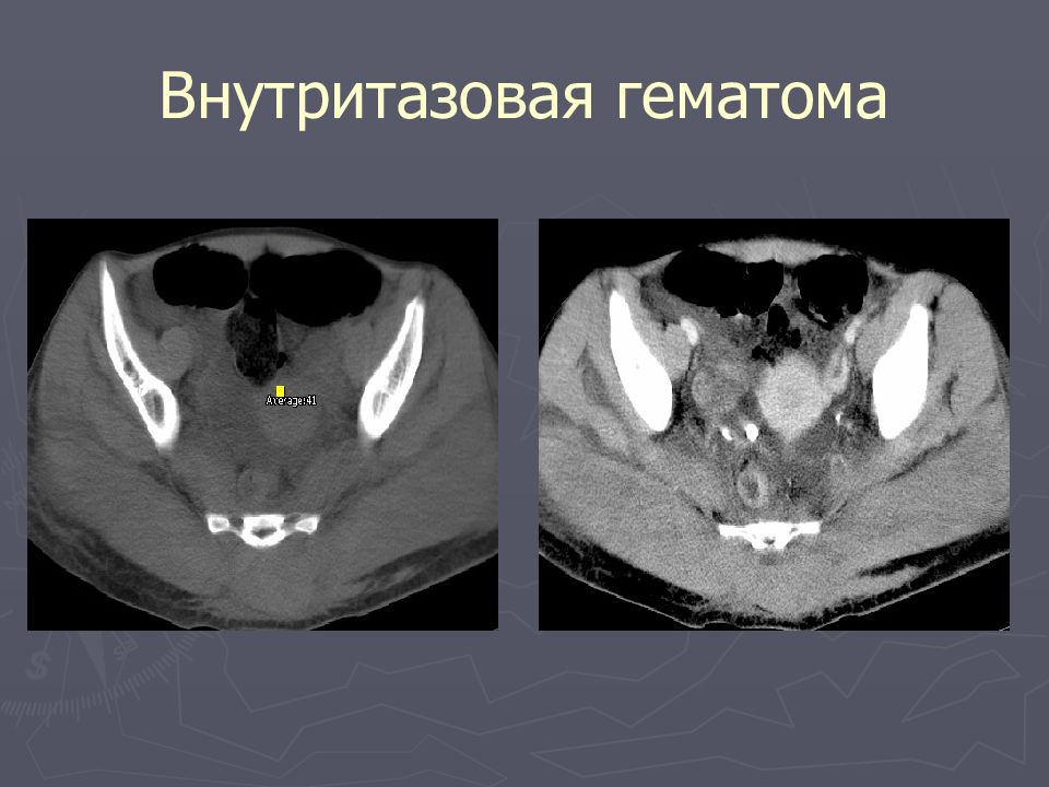 гематома передней брюшной стенки. нагноившаяся гематома мягких тканей на узи. паранефральная гематома на кт. абсцесс передней брюшной стенки кт. гематома брюшной полости кт.