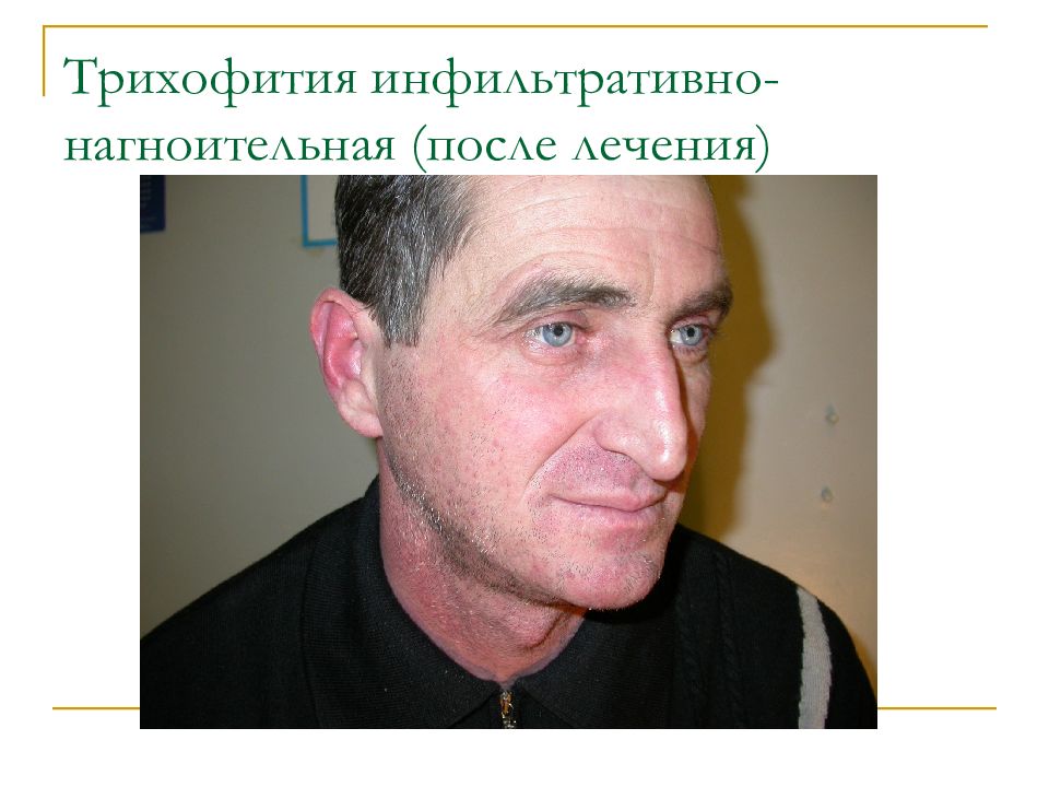 Дерматомикоз Кожи Фото