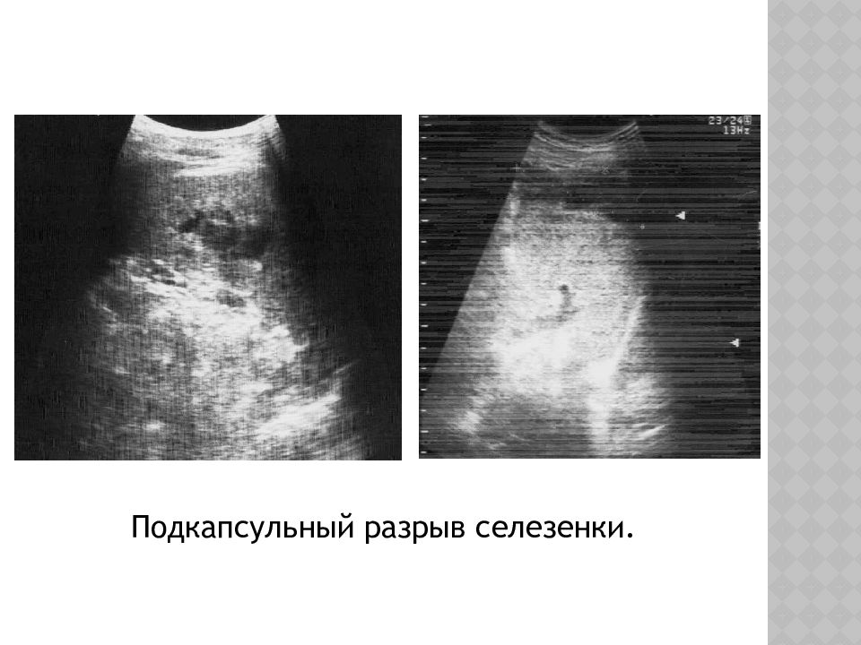 Разрыв селезенки. Чрезкапсульный разрыв селезенки. Субкапсулярная разрыв селезенки. Подкапсульный разрыв селезенки на УЗИ. Субкапсулярная гематома селезенки УЗИ.