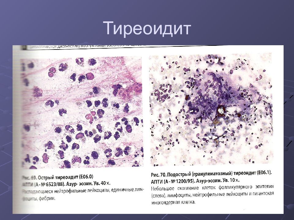 Скопление клеток фолликулярного эпителия. Подострый тиреоидит. Цитологическая диагностика. Цитологическая картина воспалительного процесса. Цитологическая картина неспецифического воспаления что это.