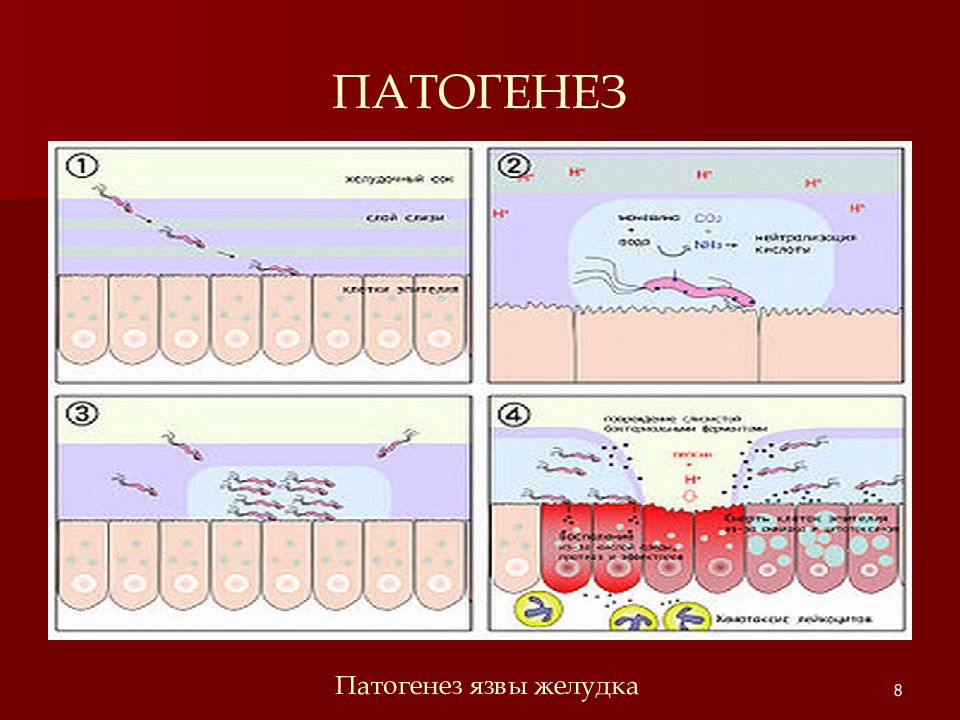 Язвенная болезнь патогенез схема