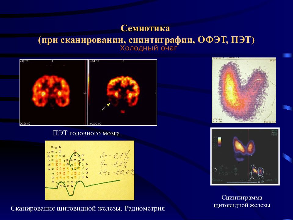 Сцинтиграфия щитовидной железы. Радионуклидное сканирование щитовидной железы. Холодный очаг при сцинтиграфии щитовидной железы. Сцинтиграфия щитовидной железы узлы. Холодный узел щитовидной железы сцинтиграфия.