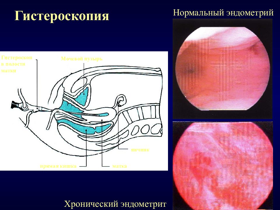 Эндометрит хронический картинки