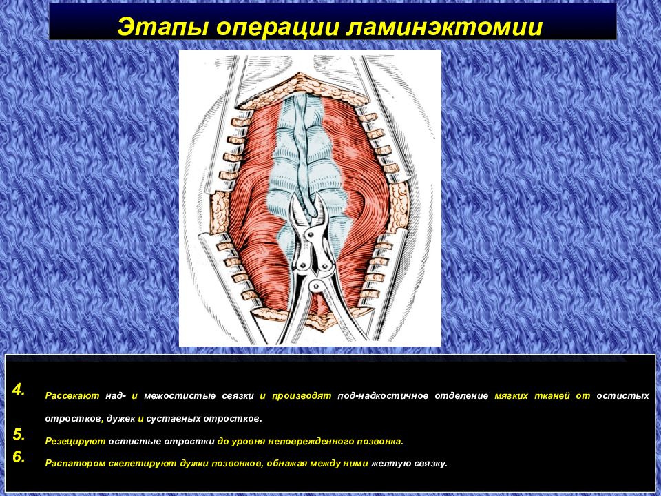Этапы операции. Ламинэктомия позвоночника этапы операции. Операция ламинэктомия на позвоночнике. Операции на позвоночнике и спинном мозге.