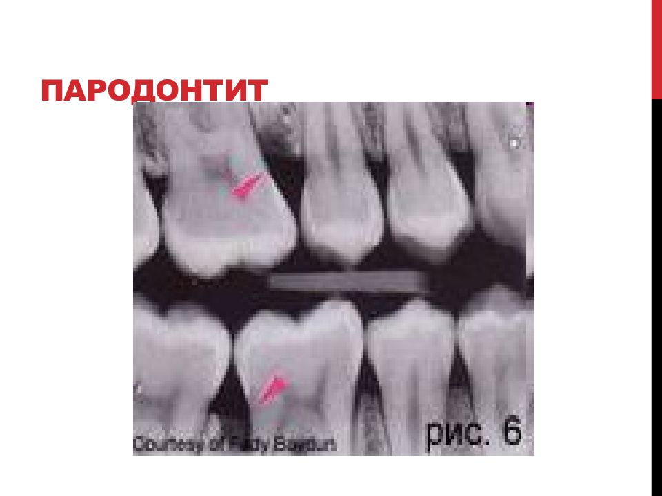 Межкорневой периодонтит. Пародонтит мкб. Пародонтит на рентгенограмме.