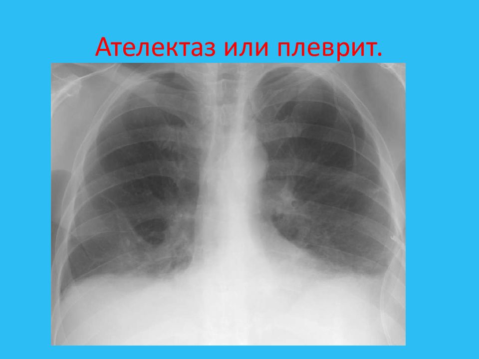 Ателектаз легкого. Субтотальный ателектаз. Ателектаз нижней доли слева рентген. Ателектаз нижней доли слева. Ателектаз левого легкого.