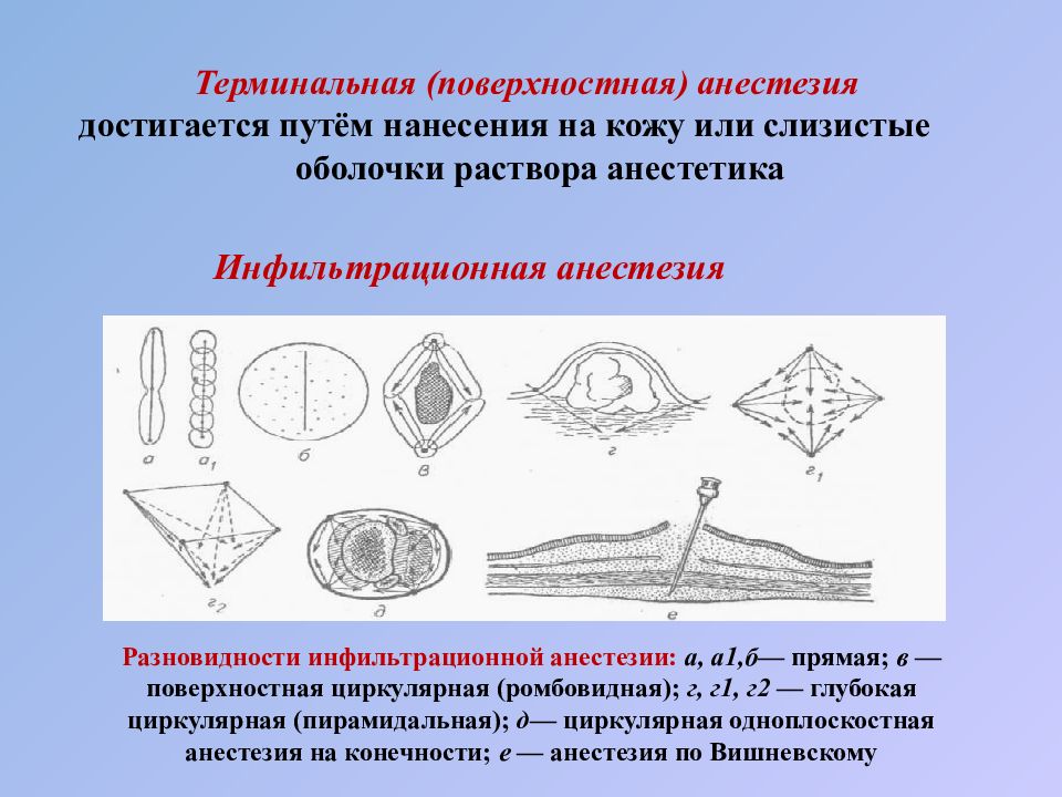 Поверхностная анестезия. Ромбовидная инфильтрационная анестезия. Терминальная поверхностная анестезия. Местная инфильтрационная анестезия. Поверхностная местная анестезия.