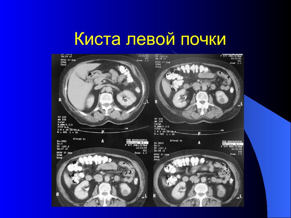 Киста левой почки симптомы