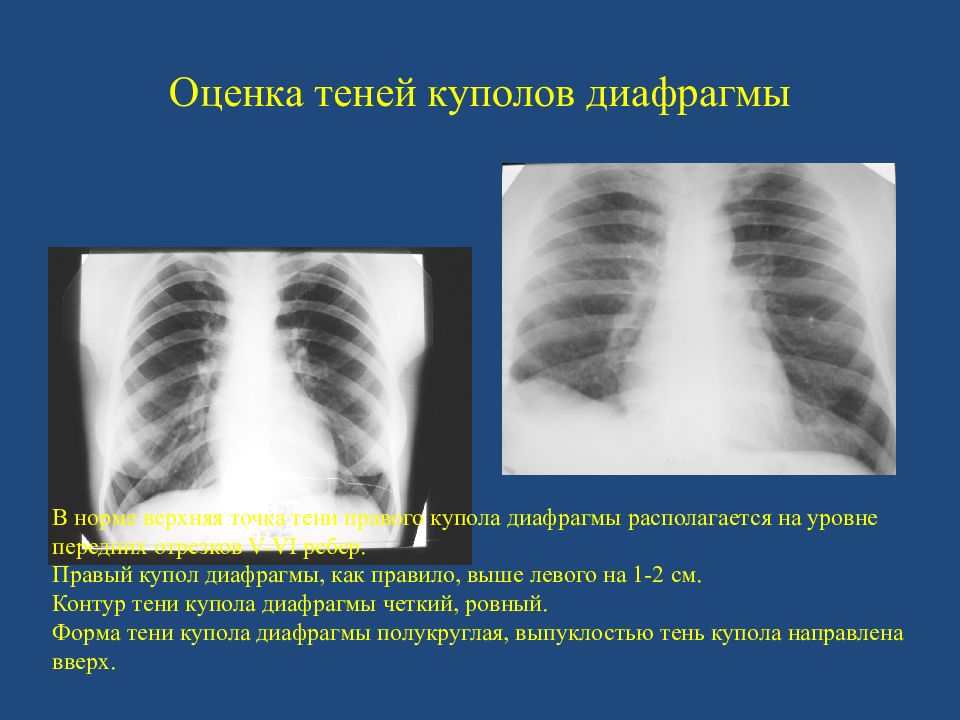Диафрагма строение и функции. Купол диафрагмы определяется. Диафрагма. Купол диафрагмы определяется. Купол диафрагмы определяется.