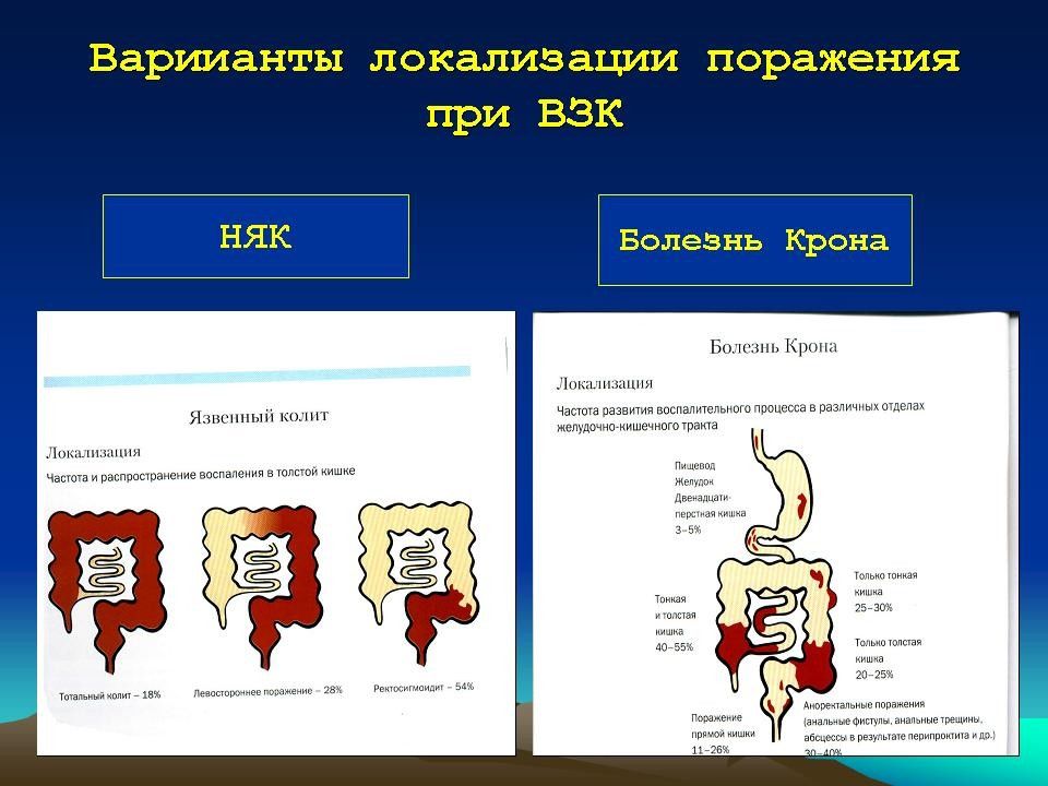 Локализация поражения. Болезнь крона классификация по локализации. Локализация при болезни крона. Локализация поражений при болезни крона. Локализованная болезнь крона.