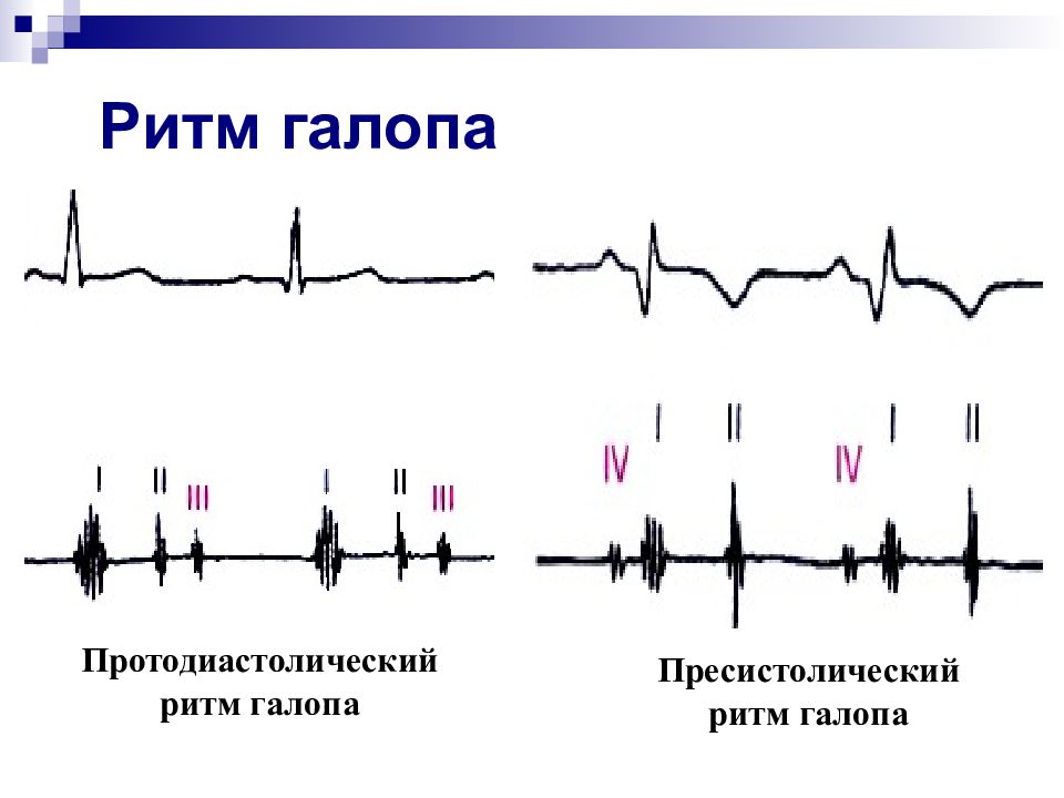 Графическое изображение тонов сердца