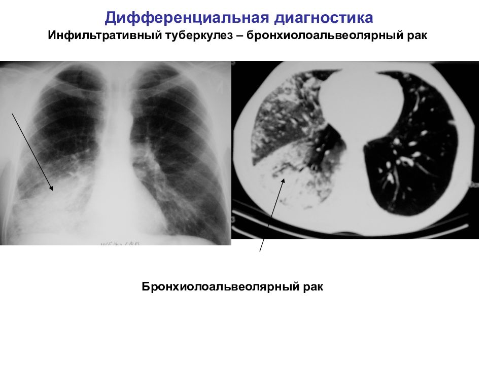 Бронхоальвеолярный рак презентация