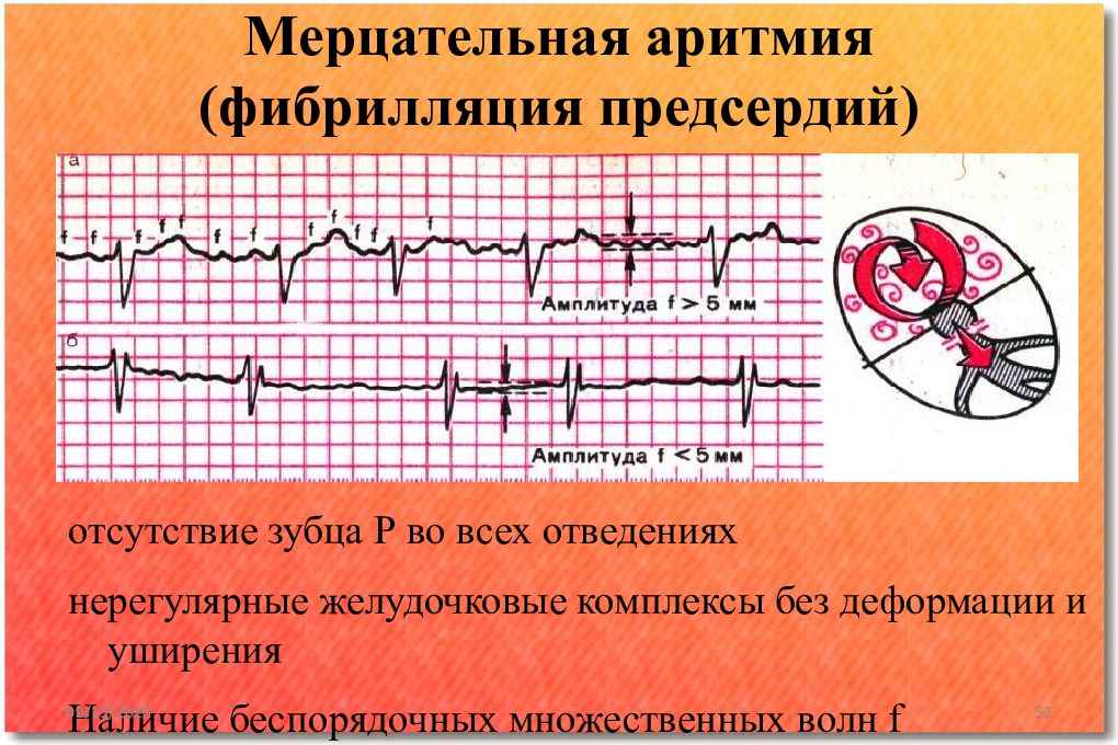 Что такое мерцательная аритмия. Фибрилляция предсердий волны ф. Фибрилляция предсердий и желудочковая экстрасистолия. Мерцательная аритмия фибрилляция предсердий. Желудочковая Мерцательная аритмия на ЭКГ.
