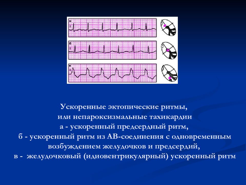 Эктопический ритм. Ритм из av соединения на ЭКГ. Эктопический ритм сердца на ЭКГ. Ускоренный предсердный ритм. Ускоренный эктопический ритм на ЭКГ.