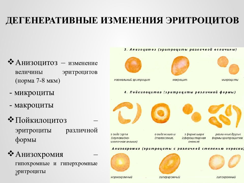 Макроциты. Анизоцитоз микроцитоз. Анемии по форме эритроцитов. Изменение формы эритроцитов (пойкилоцитоз). Патологические формы эритроцитов анизохромия.