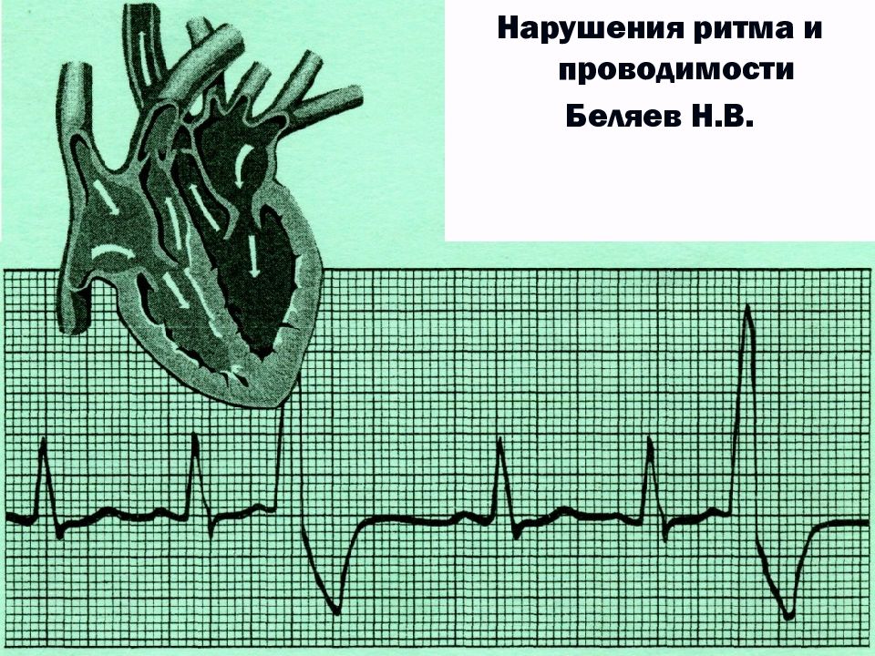 Нарушения ритма презентация