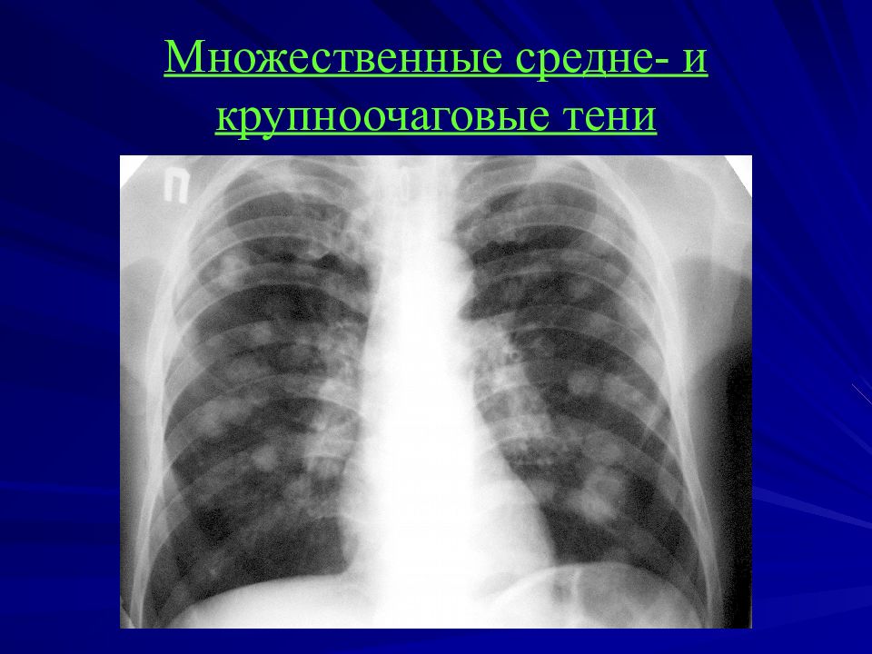 Округлое затемнение. Очаговый туберкулез рентген. Очаговый туберкулез рентген кт. Рентгенодиагностика заболеваний легких. Множественные очаговые тени в легких.