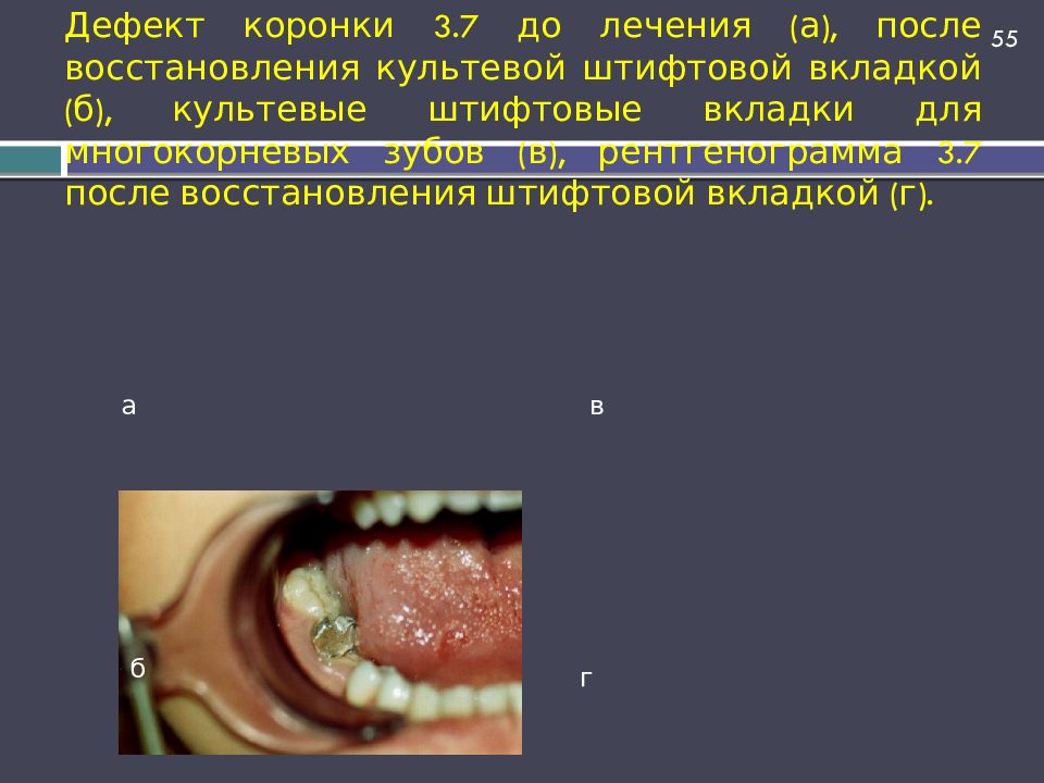 Дефект коронки 3.7 до лечения (а), после восстановления культевой штифтовой вкладкой (б), культевые штифтовые вкладки для многокорневых зубов (в),