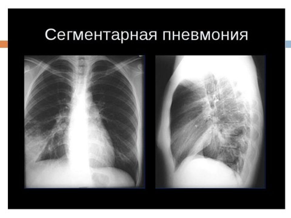 Рентгенологическая картина пневмонии у детей