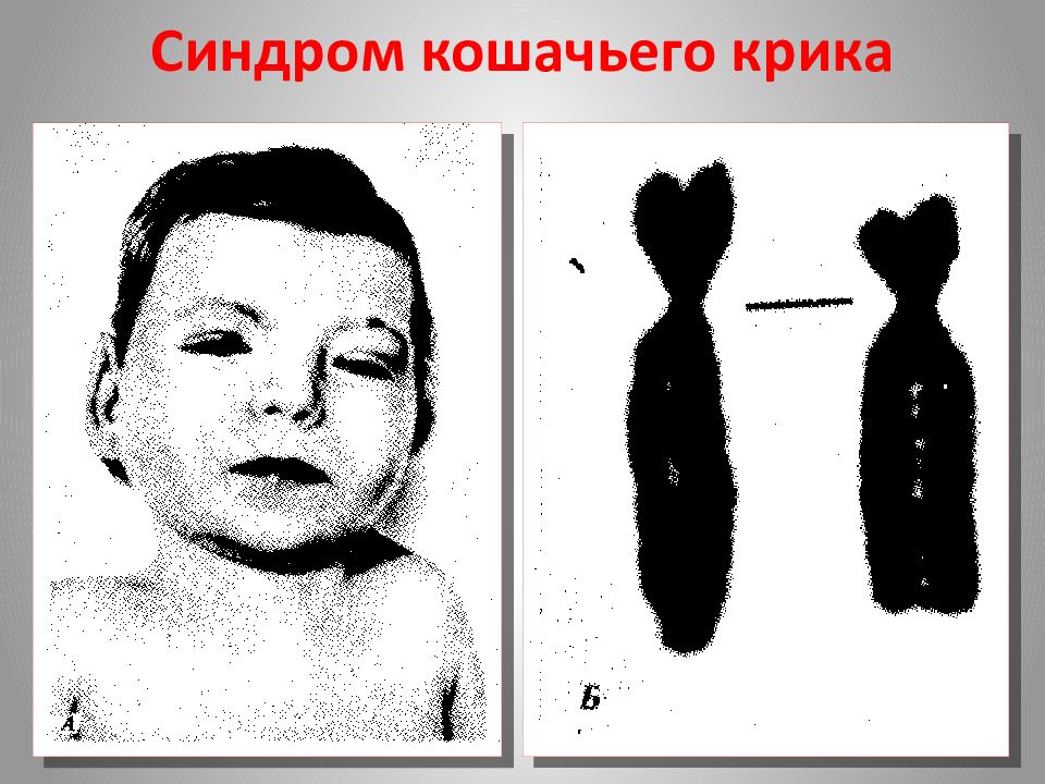 Синдром кошачьего крика. Идиограмма синдрома кошачьего крика. Кариотип девочки с синдромом кошачьего крика. Синдром «кошачьего крика» (делеция 5р-). Синдром кошачьего крика (моносомия 5р).