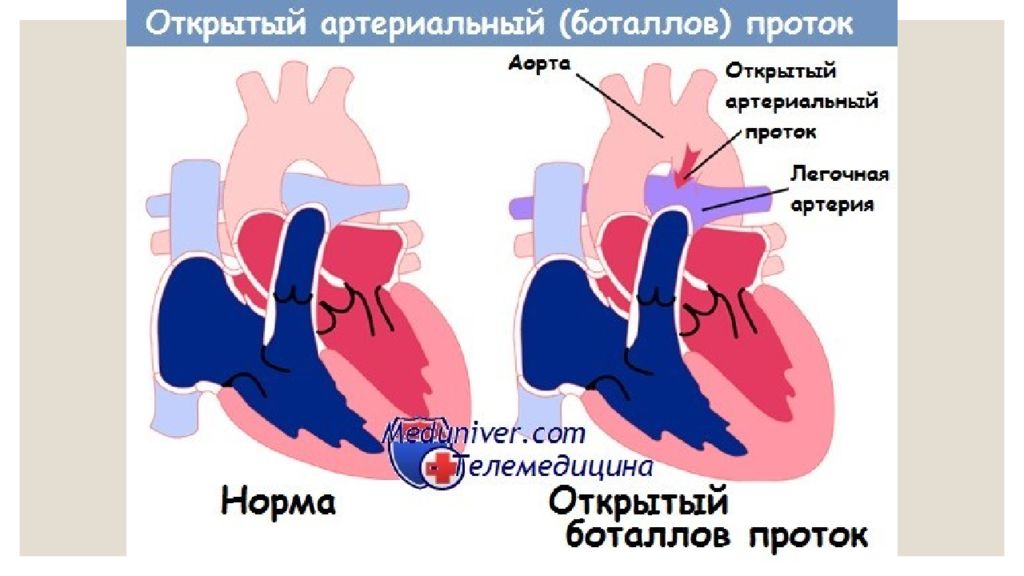 Оап у новорожденных. Открытый (персистирующий) артериальный проток. Боталлов проток гемодинамика. Открытый артериальный (боталлов) проток (ОАП). Открытый артериальный проток Баталов.
