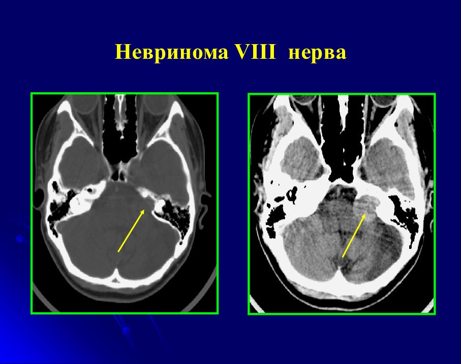 Невринома. Невринома слухового нерва рентген.