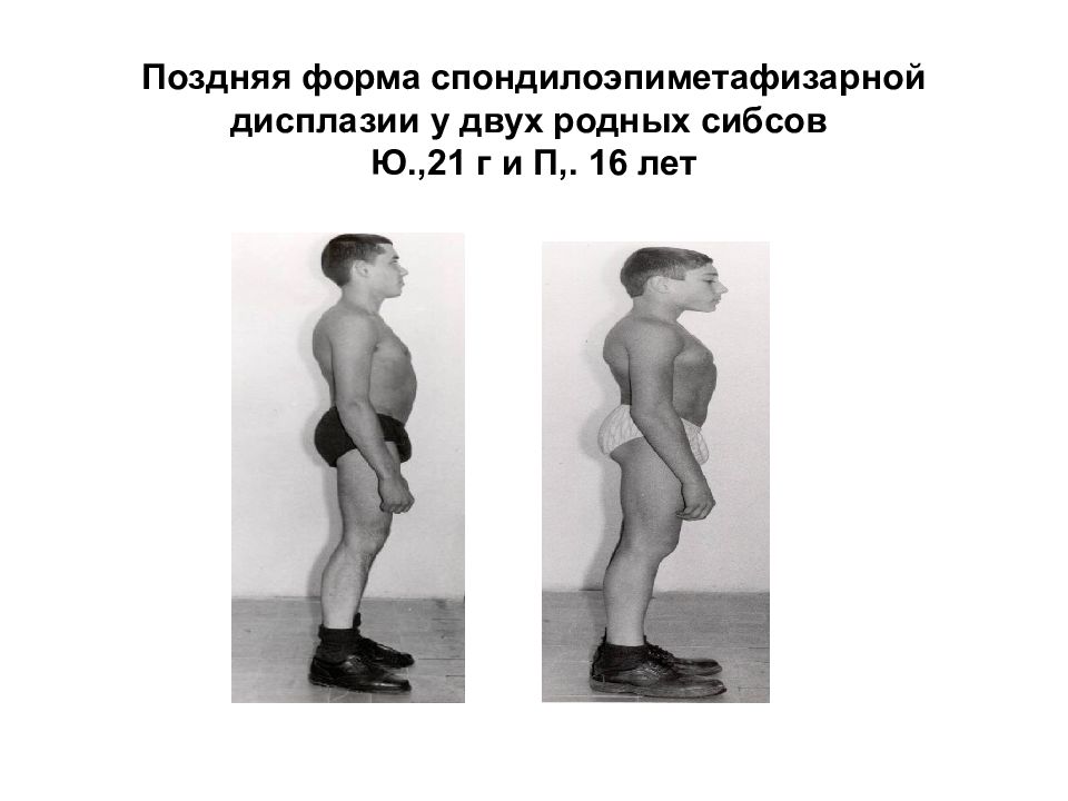 Спондилоэпифизарную дисплазию. Спондилоэпифизарная дисплазия конечностей. Спондилоэпифизарная дисплазия тазобедренных суставов. Спондилодило диафизарная дисплазия. Костно мышечная дисплазия.