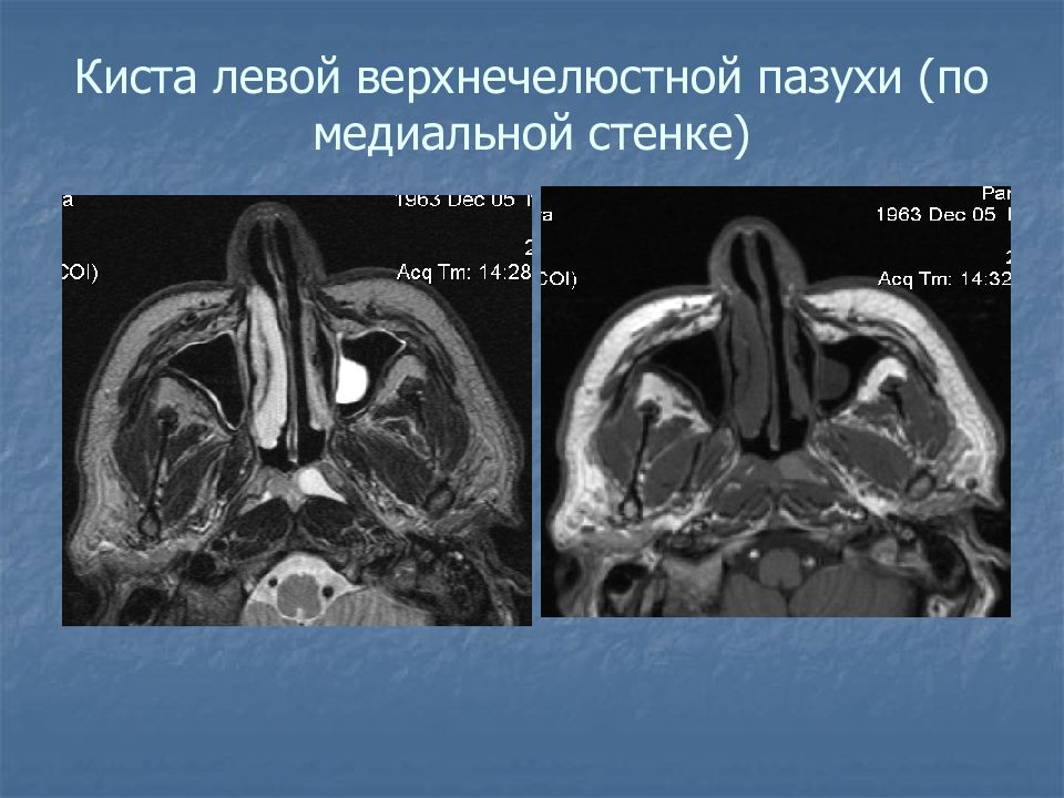 Киста на нижней стенке правой верхнечелюстной пазухи