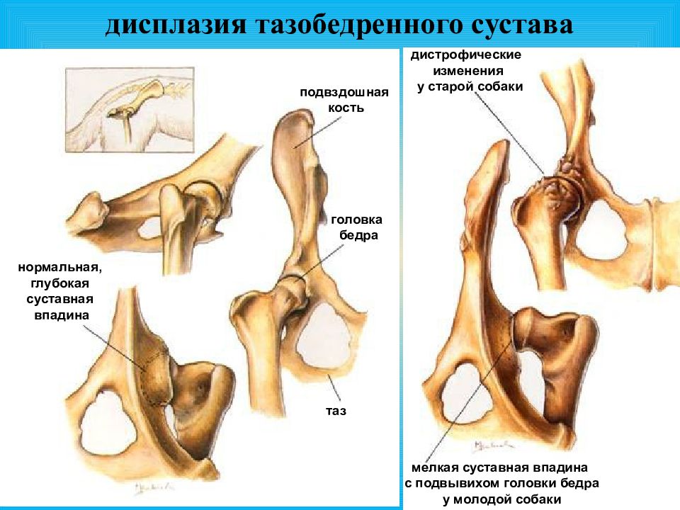 Бедренная кость тип соединения костей. Суставная впадина. Суставная впадина тазобедренного сустава. Классификация дисплазии тазобедренных суставов. Тазобедренный сустав соединение костей.