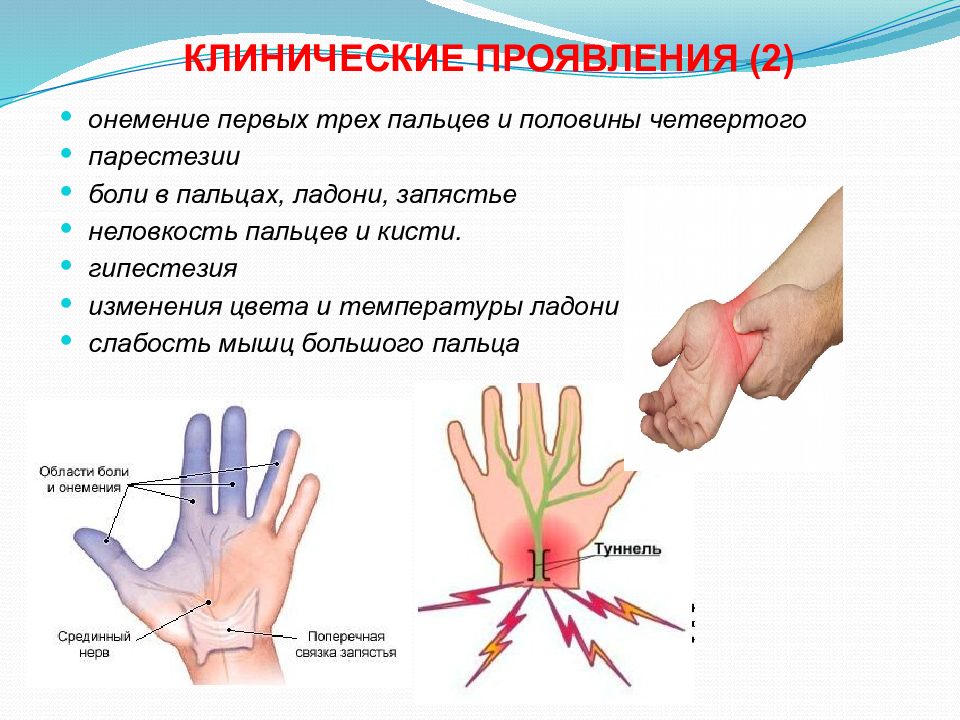 Синдром запястного канала картинки