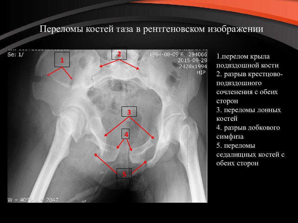 Перелом таза карта вызова