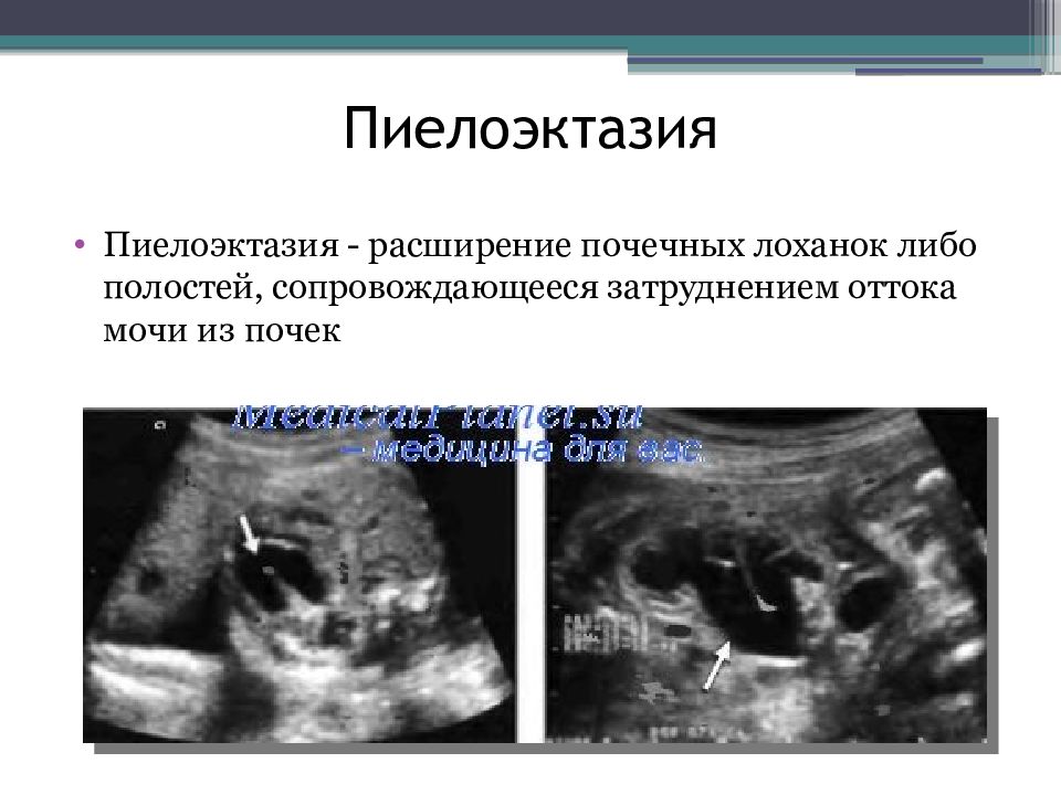 Пиелоэктазия почек что это. Пиелоэктазия левой почки УЗИ. Транзиторная пиелоэктазия что это. Пиелоэктазия на УЗИ У взрослого. Пиелоэктазия почек у ребенка на УЗИ.