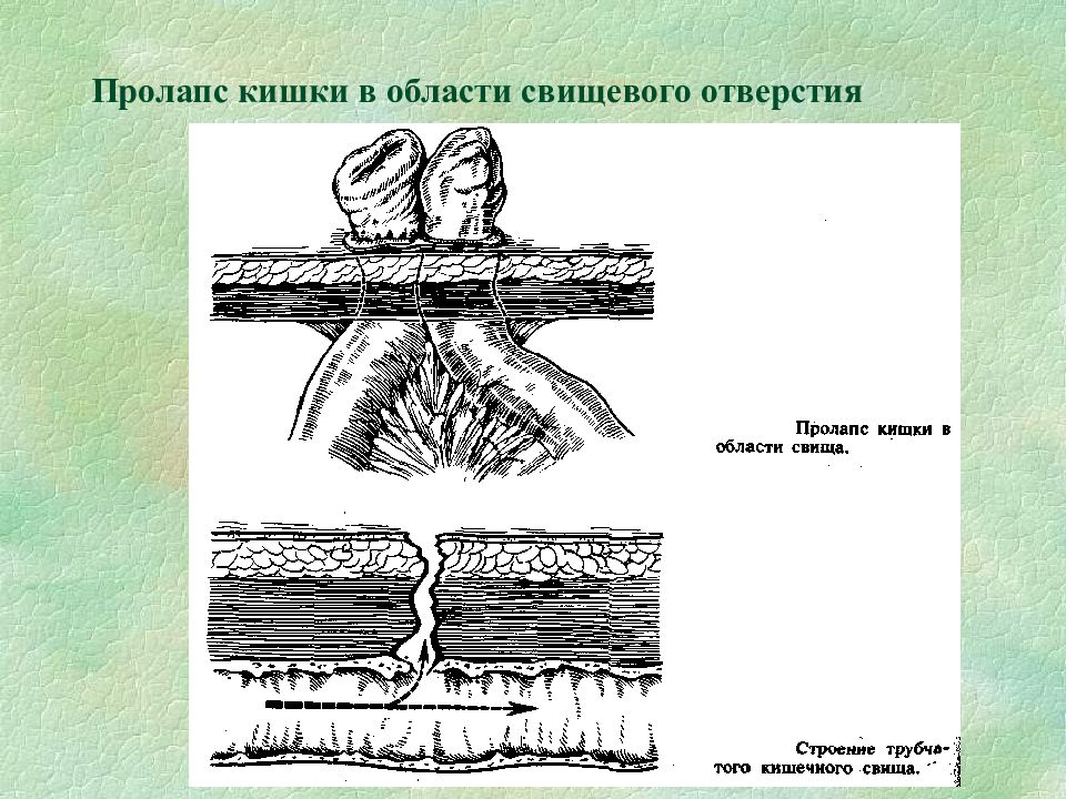 Пролапс кишечника. Тонкокишечные свищи классификация. Кишечные свищи презентация. Свищи кишечные классификация хирургия. Губовидный и трубчатый свищ.