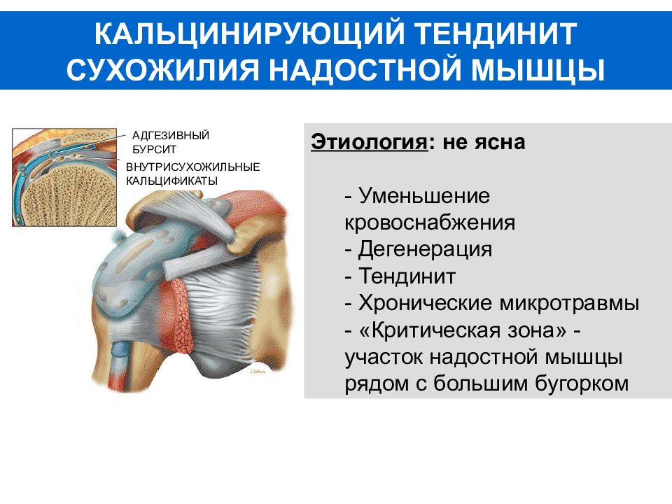 Лечение частичного разрыва мышц. Сухожилия подкостной мышцы плечевого сустава. Повреждение сухожилия надостной мышцы. Разрыв сухожилия надостной мышцы плечевого сустава. Тендинита сухожилия надостной мышцы.
