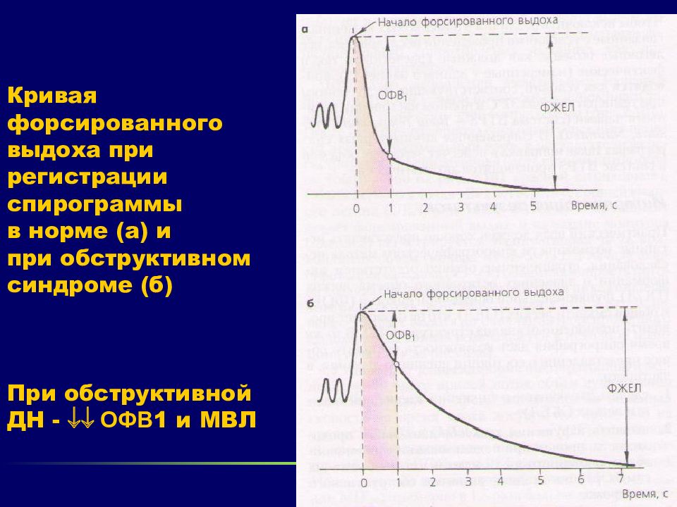 Фжел расшифровка. Обструктивная спирограмма. Спирограмма форсированного выдоха. Спирография офв1. Офв1 норма.