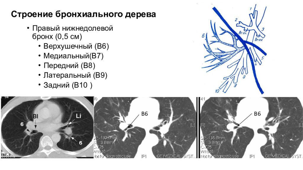 Кт бронхов. Анатомия бронхиального дерева на кт. Бронхиальное дерево на кт на кт. Анатомия бронхов на кт. Строение бронхов на кт.