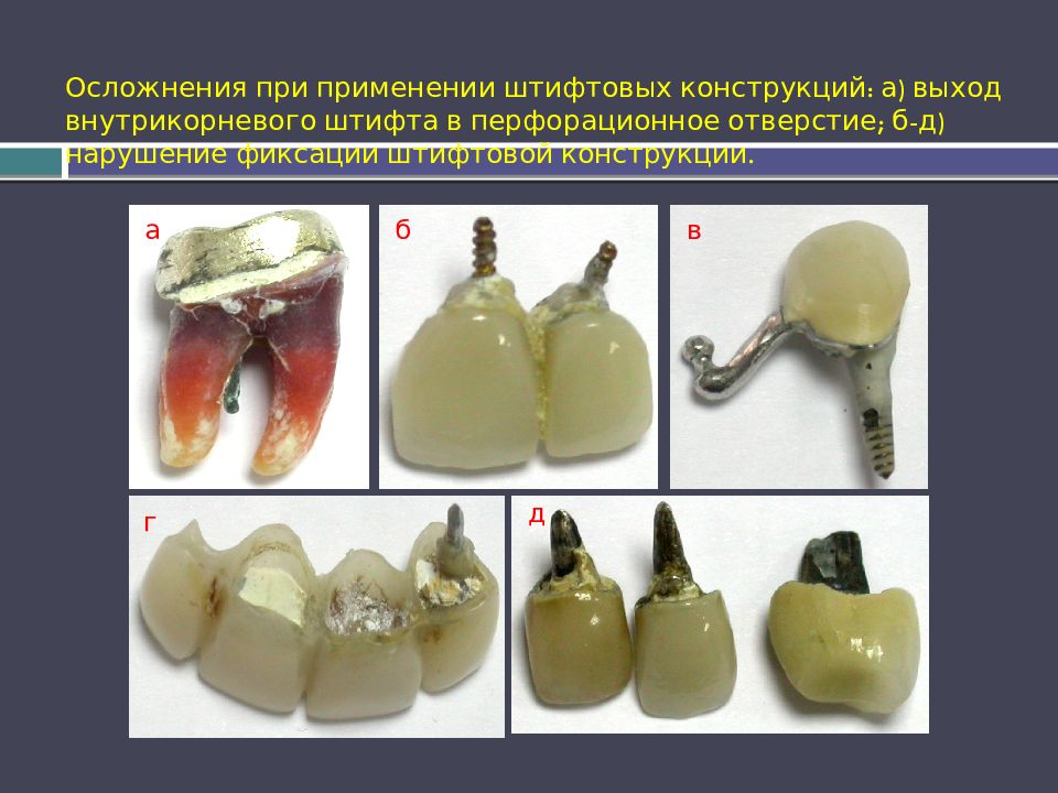Осложнения при применении штифтовых конструкций: а) выход внутрикорневого штифта в перфорационное отверстие; б-д) нарушение фиксации штифтовой конструкции.