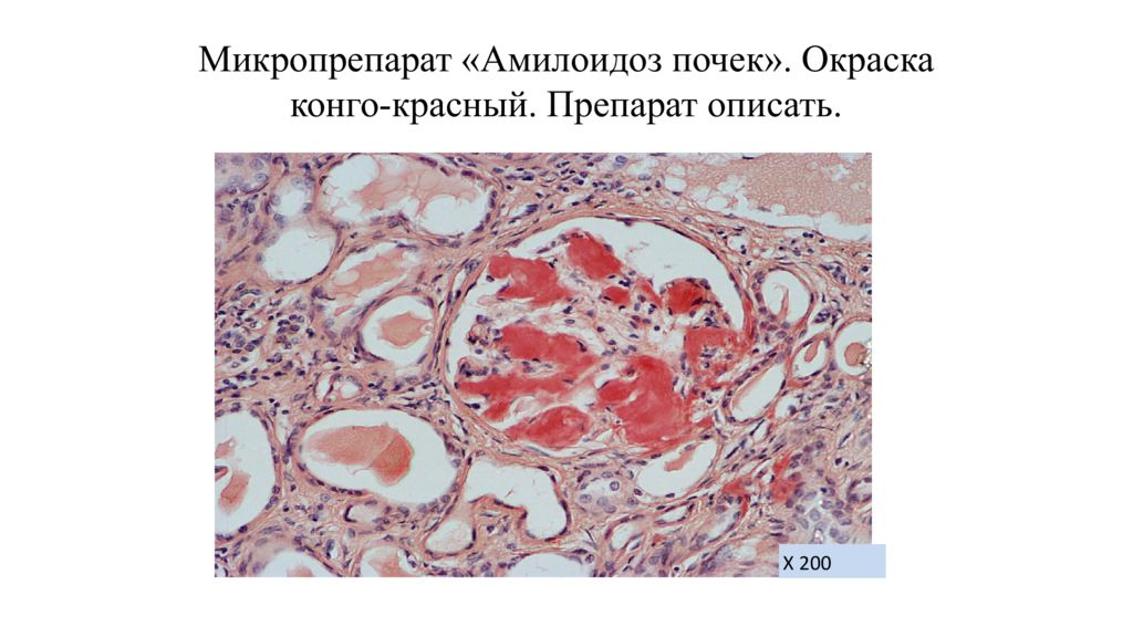 Амилоидоз почек презентация