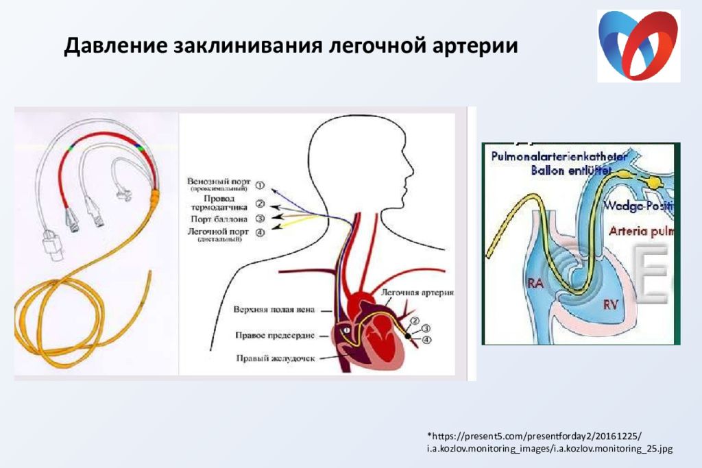 Давление в легочной артерии. Измерение давления в легочной артерии. Давление заклинивания легочной. Давление заклинивания легочной артерии. ДЗЛА давление заклинивания легочной артерии.