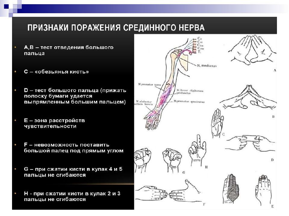 Поражение периферических нервов лучевого локтевого срединного клиническая картина