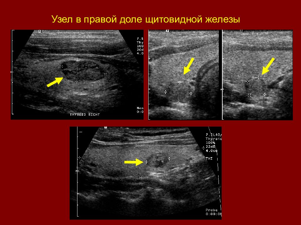 Узлы в щитовидной железе. Узел щитовидной железы 5 мм. Гиперэхогенный узел в щитовидной железе. Узел 1 см в щитовидной железе по УЗИ. Узел в левой доле щитовидной железы.