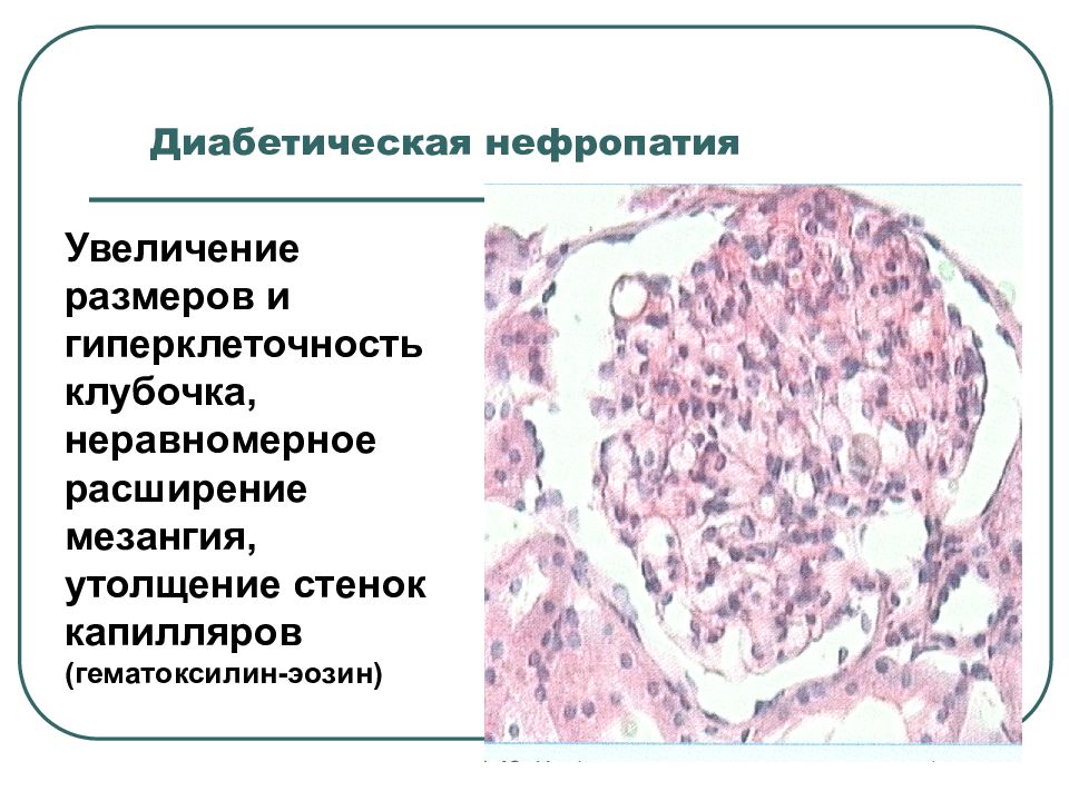Диабетическая нефропатия презентация
