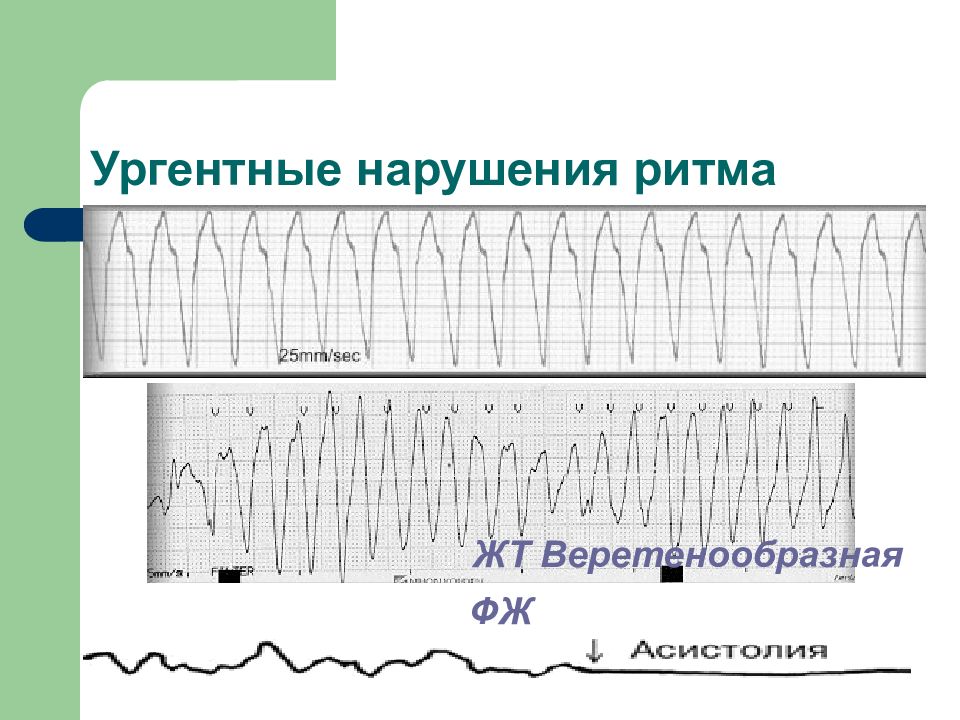 Ритм проводимости. Веретенообразное нарушение ритма. Угрожающие нарушения ритма. Веретенообразная желудочковая тахикардия. Ургентные нарушения ритма.