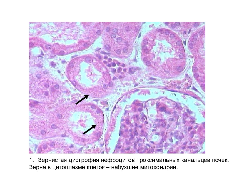 Зернистая дистрофия микроскопическая картина