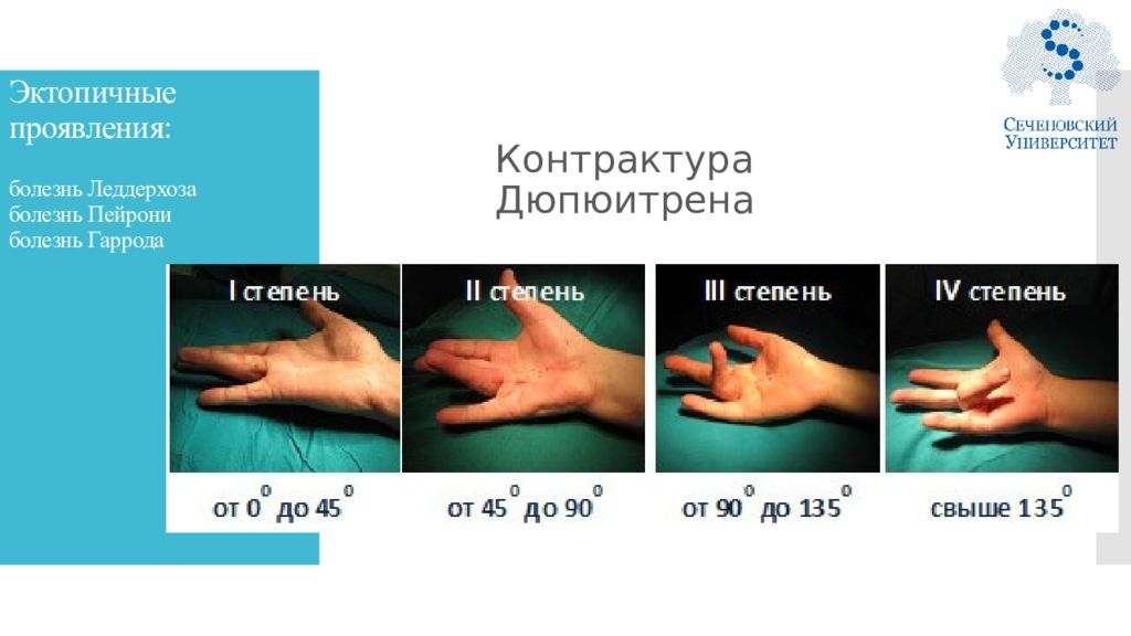 Классификация контрактур. Болезнь контрактура Дюпюитрена. Ладонный фиброматоз (контрактура Дюпюитрена). Контрактура Дюпюитрена степени.