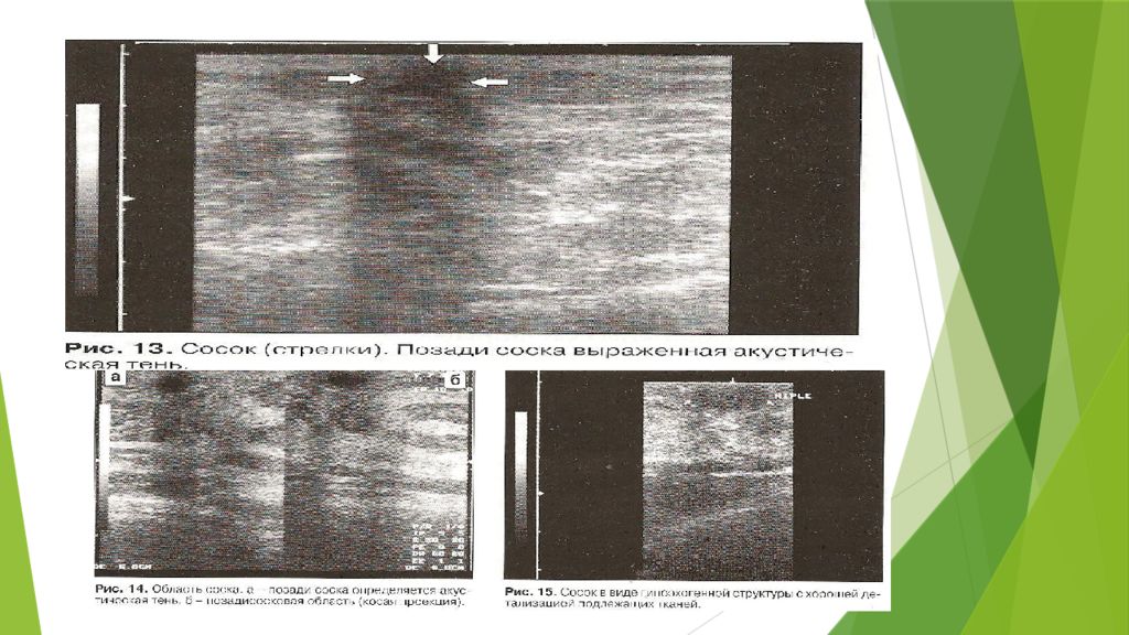 Узи молочных желез у детей. Позадисосковая область на УЗИ. УЗИ молочной железы норма. Киста молочной железы УЗИ снимок.